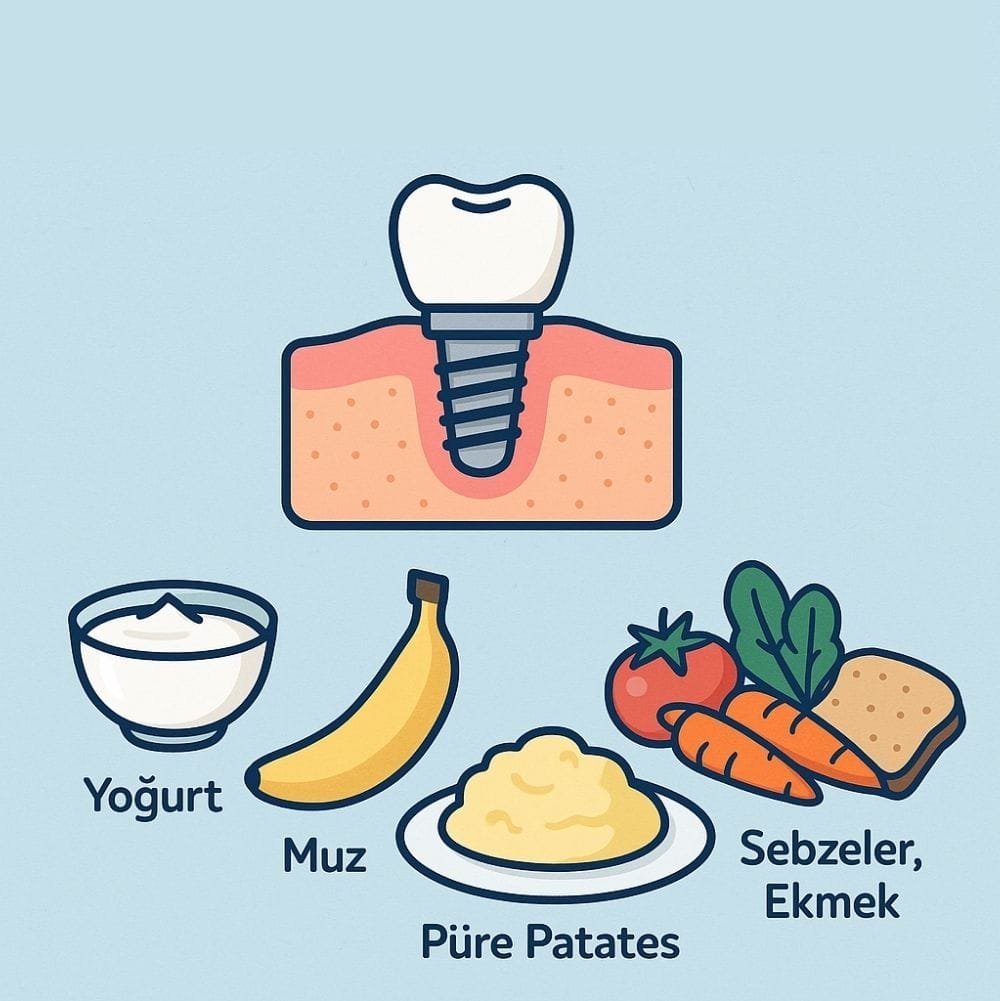 İmplant Sonrası Beslenme: Ne Zaman Ne Yiyebilirsiniz?