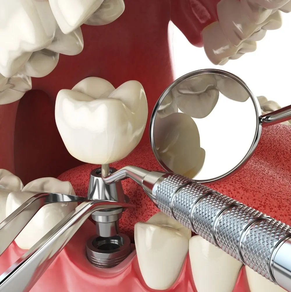 Dental Implant Cost
